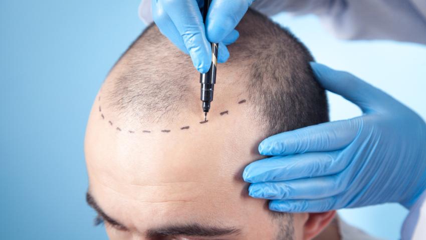 Hair Transplant