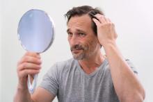 Baldness Treatment at Sparsh Clinic