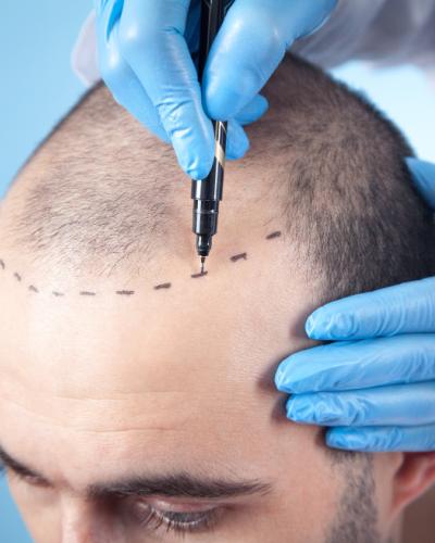 Hair Transplant